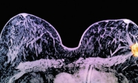 علاج جديد لسرطان الثدي يُقلِّص الورم خلال 11 يوما