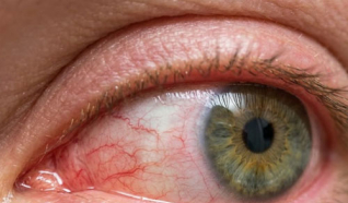 فيروس بحري ينتقل للبشر ويرتبط بمرض خطير في العين