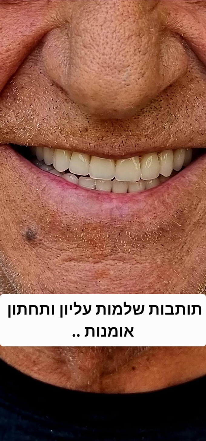 صناعة كافة أطقم الأسنان