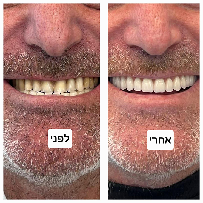 صناعة كافة أطقم الأسنان