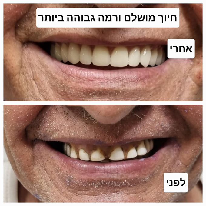 صناعة كافة أطقم الأسنان