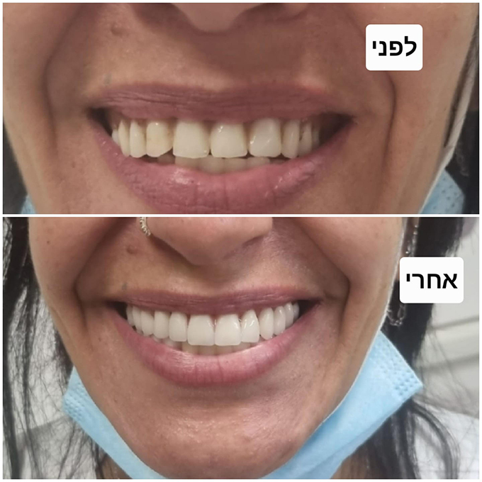 صناعة كافة أطقم الأسنان