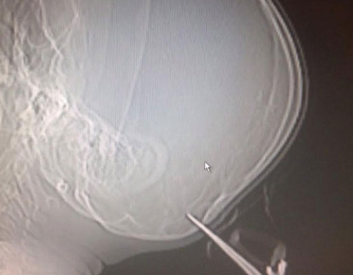نقل طفل للمشفى إثر انغراز مقص بجمجمته